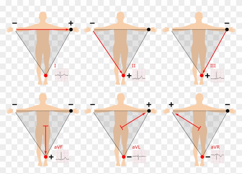 Graphic Black And White Ecg Placement Guide With Illustrations ...