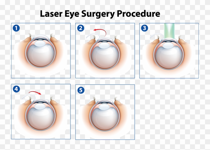 Laser Eye Surgery Procedure - Lasek Eye Surgery Diagram, HD Png ...