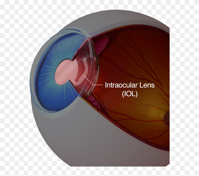 Intraocular lens. Multifocal IOL. Model Eyes for evaluation of intraocular Lenses. Intraocular Eye Liquid.